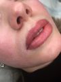 Губы сразу после процедуры 