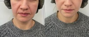 Смас лифтинг сразу после процедуры