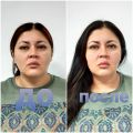 Результат после 5 сеансов скульптурно-буккального массажа лица