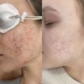 Лечение рубцов постакне с поствоспалительной гиперпигментацией