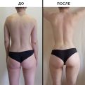 Подтяжка кожи, придание идеального силуэта, убрал лишние сантиматры