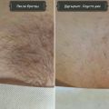 Результат шугаринга, спустя месяц, после бритвы