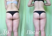 Результат антицеллюлитного массажа До и После