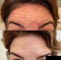 Коррекция лобных морщин 
фото ниже-результат спустя 2 недели
