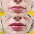 Увеличение губ 