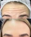 Ботулинотерапия лоб+межбровка