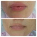 Контурная пластика губ