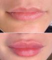 Увеличение губ Soprano18