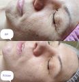 Вторая фотография сделана после второй процедуры, с интервалом две недели. 