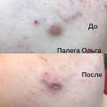 Лечение акне