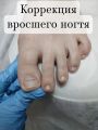 Коррекция вросшего ногтя с помощью специальной нити.
?Никакой боли: Установка проходит быстро и комфортно, а облегчение (снятие давления) чувствуется почти сразу.
?Память формы: Сплав нити всегда стремится стать ровным, мягко «вытягивая» края ногтя вверх и приучая его расти правильно.
?Эстетика: Тонкая проволочка почти незаметна, не мешает носить привычную обувь и даже покрывать ногти лаком.
?Профилактика операций: Позволяет избежать хирургического удаления вросшего ногтя.
?Универсальность: Подходит да