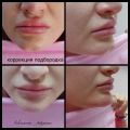Коррекция подбородка 