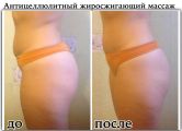 Антицеллюлитный массаж, курс 10 сеансов