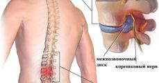 Межпозвоночные грыжи
