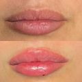Контурная пластика губ Juvederm Smail