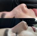 Без операционная ринопластика