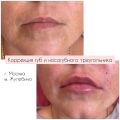 Коррекция формы и объёма губ и носогубных складок.