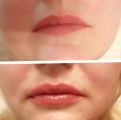 Коррекция ассиметрии губ .
