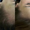Результат до и после, между фото 2 месяца 
Хорошо заросла височная область и результат продолжает нарастать 