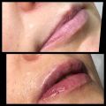 Коррекция губ филлером
