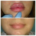 Контурная пластика губ, 1 мл филлера