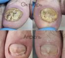 Полностью зачистили ногтевую пластину от грибка