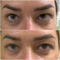 Безоперационная блефаропластика верхних век на аппарате холодной плазмы.
Выполнено 2 процедуры.