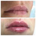 Коррекция губ филером Revanesse Канада