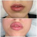 Коррекция формы губ, первичная процедура