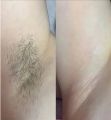 Шугаринг подмышечные впадины 