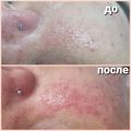Комбинированная чистка лица