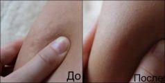 Антицеллюлитный массаж