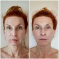 Фото до и после миопластического массажа лица .
