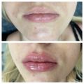 Увеличение губ 1 мл