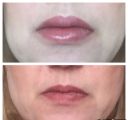Коррекция губ филером 