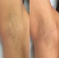 Лазерная эпиляция до/после