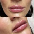 Уаеличение губ Стилаж М 1 мл. Фото через неделю после процедуры 