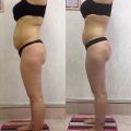 Коррекция фигуры. Фото до и после. Выполнено 10 сеансов массажа по снижению веса