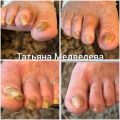 Нарушение роста (клешневидные ногти). Медицинский и эстетический педикюр в домашних условиях (пациентка малоподвижна )