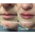 Контурная пластика губ 