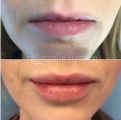 Коррекция верхней и нижний губы, 1 мл