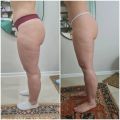 Антицеллюлитный массаж