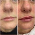 До и сразу после увеличения губ, использовался сертифицированный филлер.