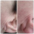 Складка перед ушной раковиной, результат одной процедуры