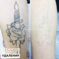 Удаление татуировок без шрамов и рубцов 