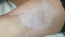 Электроэпиляция область подмышки. Сразу после процедуры, обработали циндолом