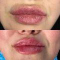До удаления старого филлера/ после 2х коррекций губ