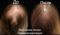 Загущение волос методом нанесения пигмента микро точками ,трихопигментация залысин