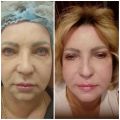 Комплексная коррекция лица.Ыиллерв , иммобилизирующая процедура для разглаживания мимических морщин.
До и после процедуры на следующий день.