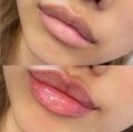 Контурная пластика губ филлером гиалуроновой кислоты